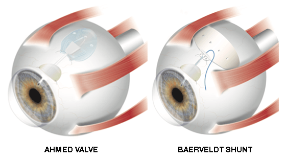 Glaucoma valve and shunt surgery