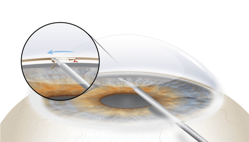 Goniotomy Eye Surgery in Sherman TX