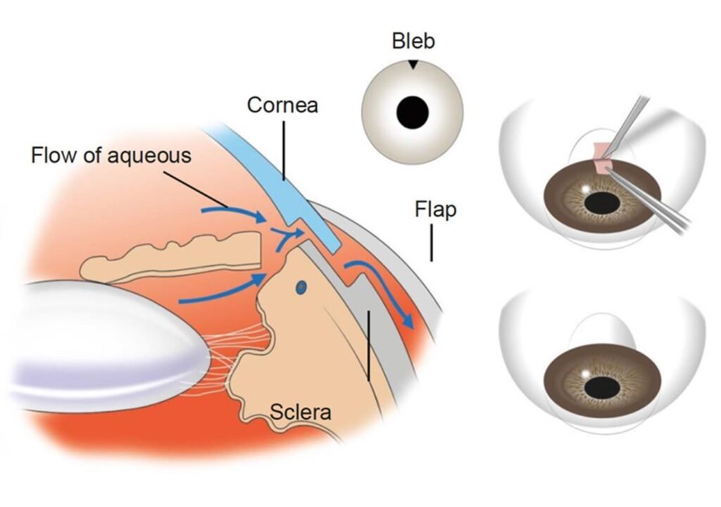 Trabeculectomy Surgery in Sherman TX